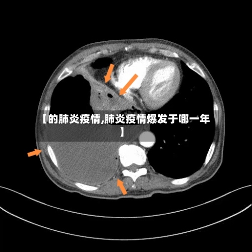 【的肺炎疫情,肺炎疫情爆发于哪一年】