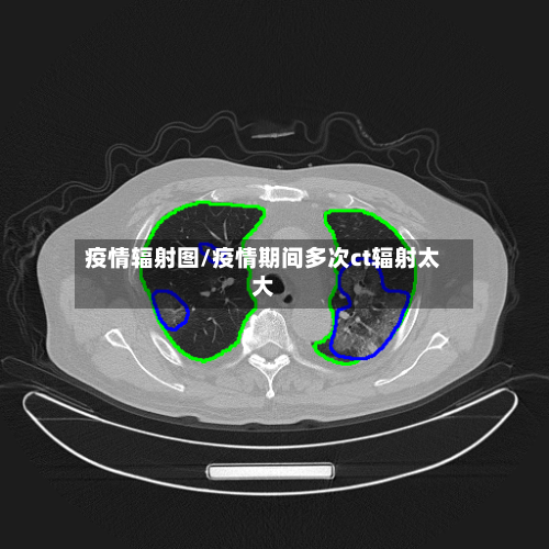 疫情辐射图/疫情期间多次ct辐射太大