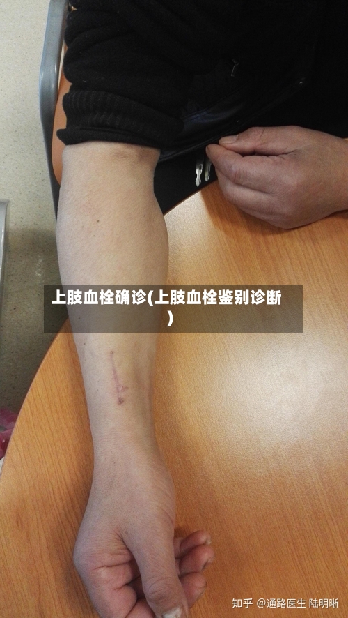 上肢血栓确诊(上肢血栓鉴别诊断)-第3张图片